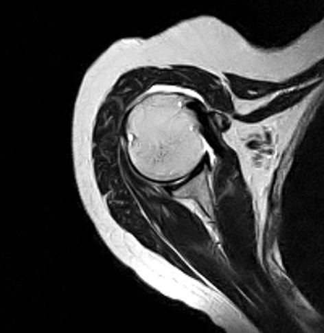 Shoulder Axial MRI Scan